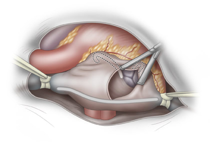 Illustration of right atrial lesions during MAZE procedure