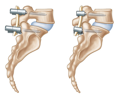 Illustration of the placement of the S4 Spinal System in lumbar vertebrae