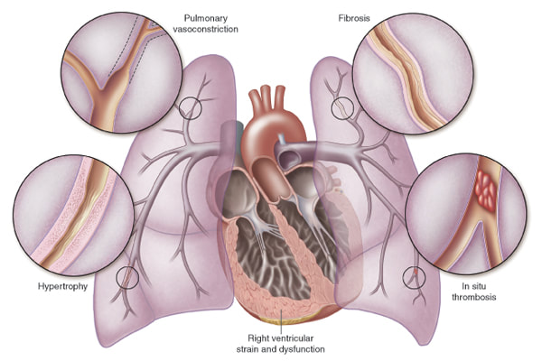 Illustration of the symptoms of pulmonary hypertension