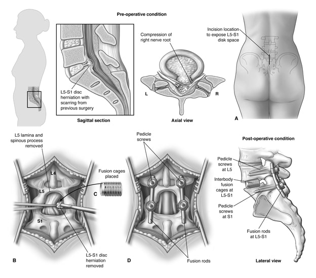 	Illustration of steps to complete posterior lumbar spinal fusion