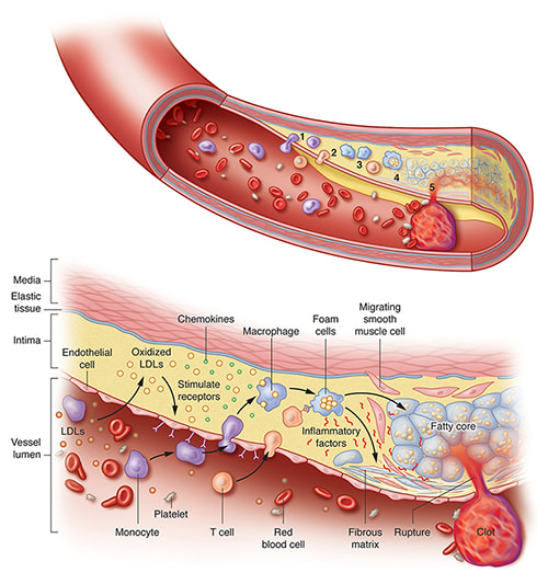 Illustration of the initiation and progression of atherosclerosis