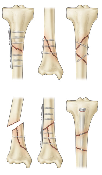 	Illustration of tibial fracture types and fixation