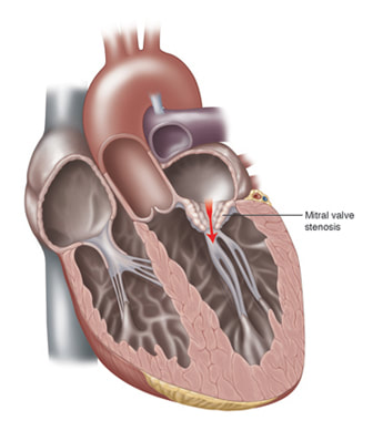 Illustration of the heart depicting mitral valve stenosis