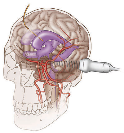 Illustration of the skull with brain and ventricles; modes of measuring intracranial pressure